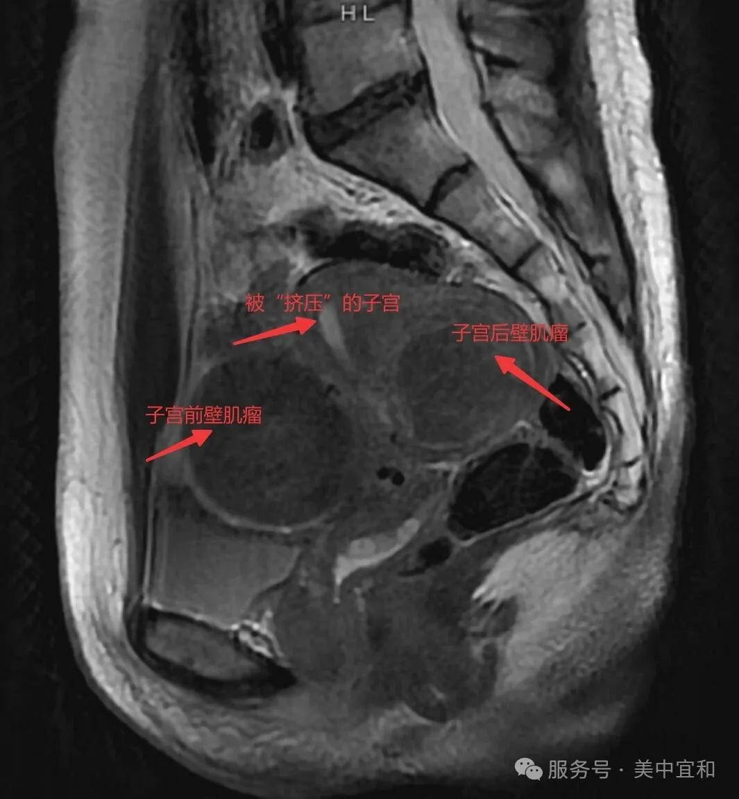 MRI scan showing fibroids on anterior and posterior uterine walls