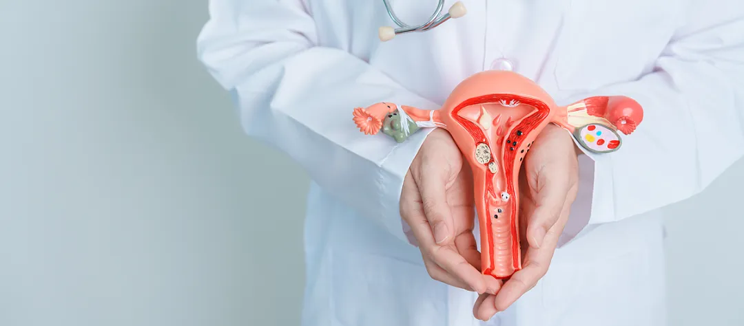 Doctor holding a uterine model showing fibroid development