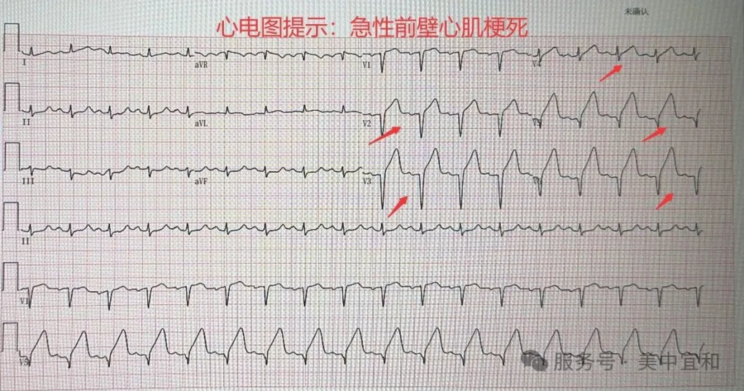 ECG showing acute anterior wall myocardial infarction at AMCARE Beijing