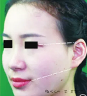 Mid-face treatment range diagram used in Chinese facial rejuvenation expert consensus