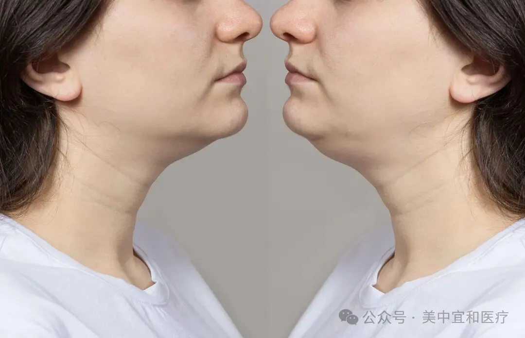 Lower facial sagging along the jawline and marionette area
